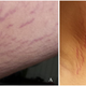 The “stretch mark” lesions that finally unraveled the boy’s mystery ailment, photographed in February 2017.